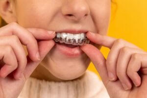 clear aligner trays in an orthodontic clinic